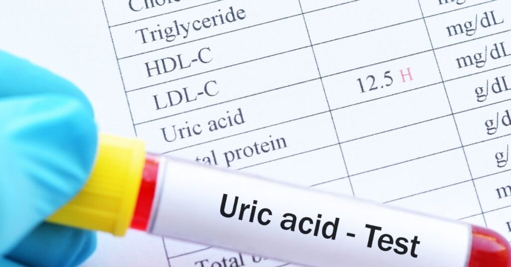 Blutprobe für einen Harnsäuretest zur Kontrolle erhöhter Harnsäurewerte und des Gichtrisikos.