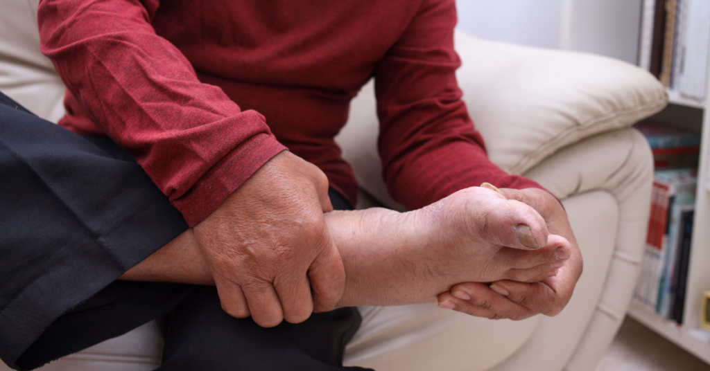 Person hält schmerzhaften Fuß – Gelenkschmerzen können ein Hinweis auf erhöhte Harnsäure und einen möglichen Gichtanfall sein.